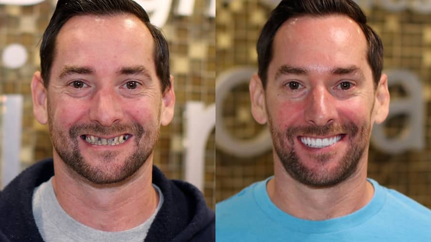 Innovative Implant Smile before and after.